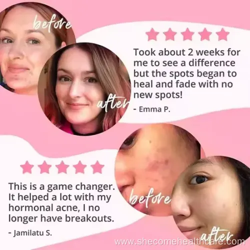 Vegan Acne Capsule for Oily Skin